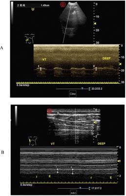 Early diaphragm dysfunction assessed by ultrasonography after cardiac surgery: a retrospective cohort study